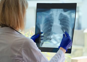 A person wearing blue gloves holds a chest X-ray, looking at the image carefully.