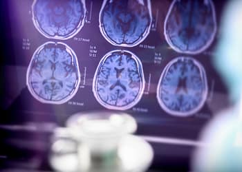 Brain CT images on a screen, with a cup and a blurred background.