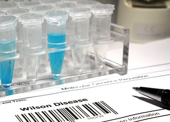 Laboratory vials with blue liquid inside, placed on a transparent stand, next to a form that says 'Wilson Disease' at the bottom and a black pen on the right side.