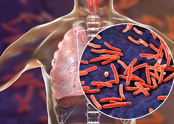 Medical illustration of a human torso with the lungs highlighted and a close-up of red bacteria on a dark background, depicting a lung infection.