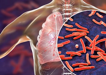 Illustration of a human body with the lungs highlighted and a close-up of rod-shaped bacteria, representing pathogens.