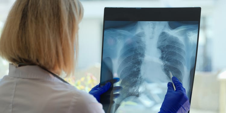 A person wearing blue gloves holds a chest X-ray, looking at the image carefully.