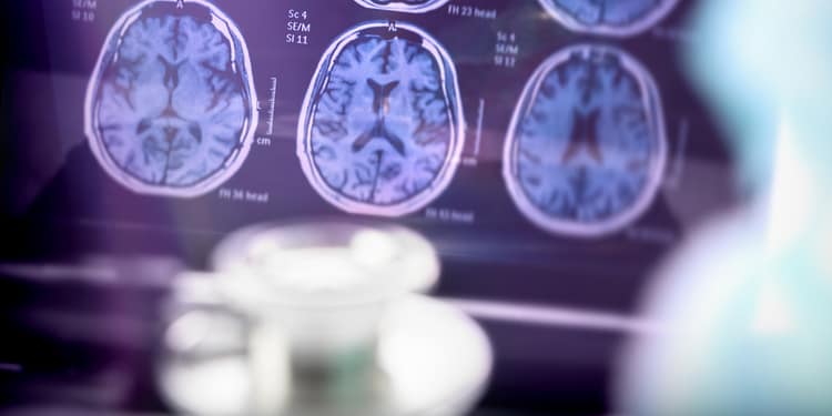 Brain CT images on a screen, with a cup and a blurred background.