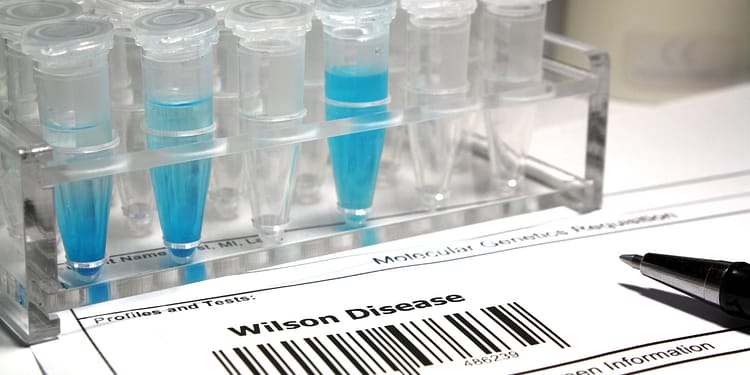 Laboratory vials with blue liquid inside, placed on a transparent stand, next to a form that says 'Wilson Disease' at the bottom and a black pen on the right side.