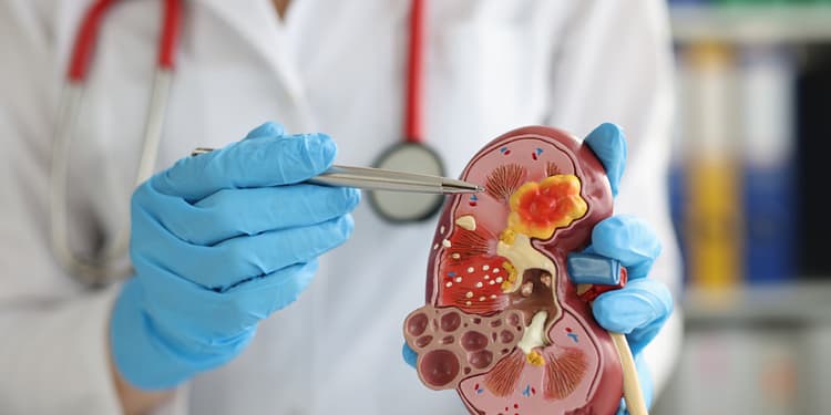 Un modelo anatómico de un riñón humano es sostenido por un médico con guantes azules, que utiliza una pinza para señalar una parte específica del riñón, mostrando la anatomía interna con destacadas estructuras en colores rojo y amarillo en un entorno clínico.