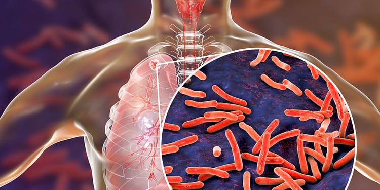 Medical illustration of a human torso with the lungs highlighted and a close-up of red bacteria on a dark background, depicting a lung infection.